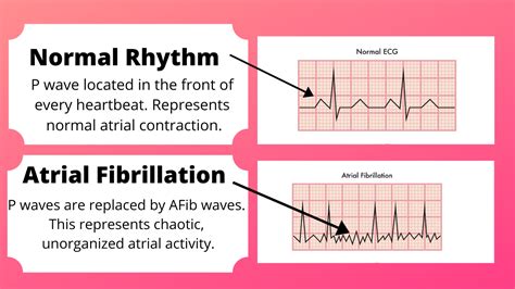 rapid or irregular beating of the heart figgerits|Atrial fibrillation: What you need to know .